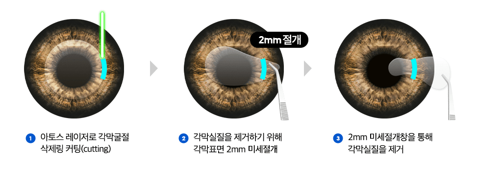 기존 라식·라섹의 단점을 보완한 뉴스마일 라식 - 하늘안과