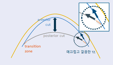 아토스(ATOS)장비의 특징 - 하늘안과