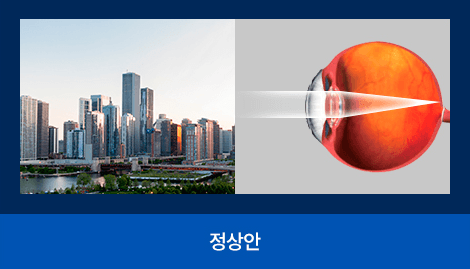 정상안: 선명하게 보이는 시야