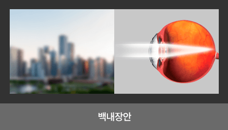 백내장안: 뿌옇고 흐리게 보이는 시야