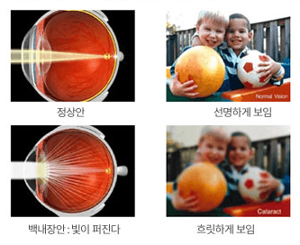 백내장의 원인 - 하늘안과