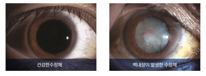 백내장의 원인 - 하늘안과