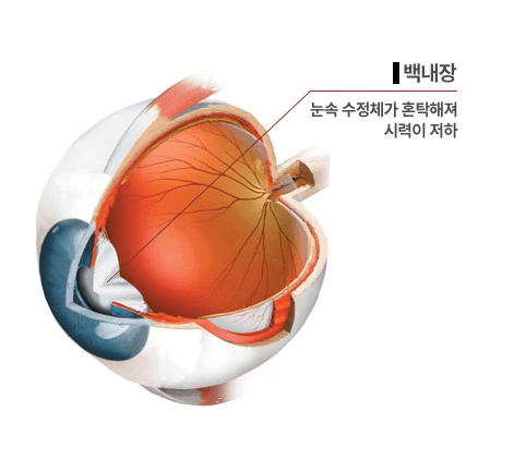 백내장의 원인 - 하늘안과