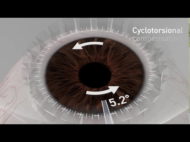뉴스마일라식 Cyclotorsion 보정 영상: 눈 회전 5.2도 추적 장면