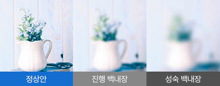 백내장 증상 예시: 시력저하